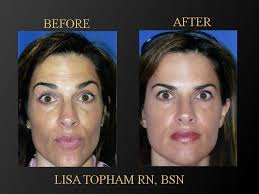 30 days after treatment, the majority of dysport users (88%, 85% and 86% in each of the 3 studies vs. Dysport Injections Fairfield County Facial Fillers Cheek Fillers Wilton Greenwich