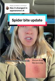 Spider Bites with Red Lines