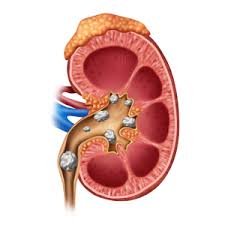 Kidney Stones In Children Niddk