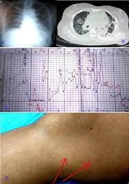 the patients imagings fever chart and rash a chest