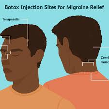 If injection sites are marked in ink, do not inject botox directly through the ink mark to avoid a permanent tattoo effect. Botox For Chronic Migraine Prevention