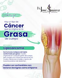 Image result for Liposarcoma