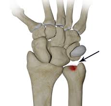 Figure 17 From Imaging Findings In Ulnar-Sided Wrist Impaction Syndromes. |  Semantic Scholar