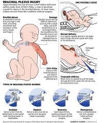 Waiter's tip position erb's palsy. Erb S Palsy Or Waiter S Tip Hand In The Neonates Medizzy Journal