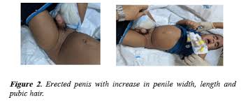 Image result for Precocious Puberty