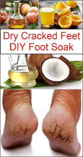 It gently dissolves away old, dead skin cells and helps to prevent both toenail fungus and calluses. Listerine Vinegar Foot Soaks And Uses Listerinefo6m18 On Flipboard