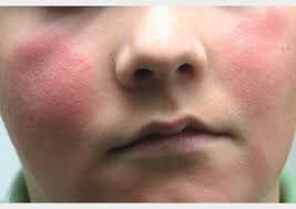 But depending on its underlying cause. Rashes In Children Learning Article Pharmaceutical Journal