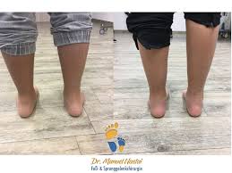 Talo Calcaneare Arthrorise Mit Talus Stopp Schraube Dr Medic Manuel Nastai