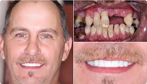 Invisalign in Hillsborough, NJ