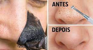 Remova cravos com facilidade | melhor limpeza de pele caseira. Tudo Sobre Cravos Do Nariz O Que Fazer Para Remover Cravos Do Nariz Mascara Para Remover Cravos Do Nariz E Como Remover Cravos Do N Hair Beauty Beauty Body