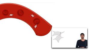 Sometimes, the condition doesn't cause any problems at all. Blut Thrombozyten Clipdocs