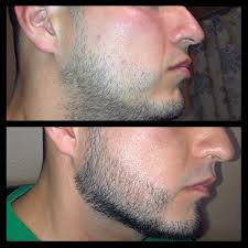 Next, we have this awesome viking beard. Minoxidil Beard Growth Real Before And After Photos