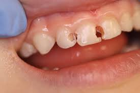 How long does she brush? How Long Does It Take To Fill A Cavity In A Child Teethwalls