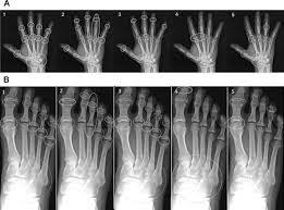 Rheumatoid arthritis (ra) is a chronic systemic inflammatory disease of unknown cause. Conventional Radiology In Rheumatoid Arthritis Radiologic Clinics
