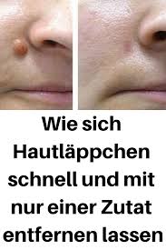 Wie Sich Hautlappchen Schnell Und Mit Nur Einer Zutat Entfernen Lassen Hautlappchen Entfernen Schnell Skin Conditions Skin How To Remove
