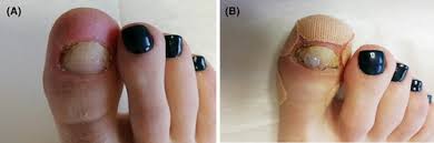 Image result for Onychotillomania feet