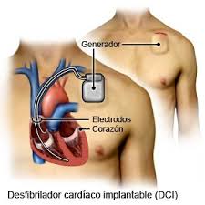 Desfibrilador cardíaco monofásico portátil de alta calidad barato de china. Desfibrilador Cardioversor Implantable Discharge Care Care Guide Information En Espanol