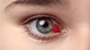 Image result for Hyphema