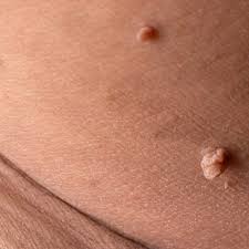 Image result for Skin Tag