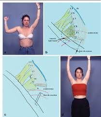 Supraclavicular Approach For Thoracic Outlet Syndrome Semantic Scholar