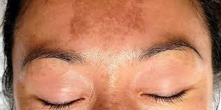 Mesmo que seja um caso recorrente de melasma, é importante verificar com o especialista o tipo e. Pin En Ecocosas