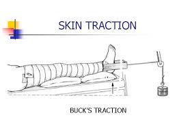 How to apply bucks traction and education. Care Of Client With Musculoskeletal Injury Or Disorder