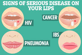 Image result for Lip Cancer
