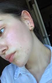 What's your best skincare for fungal acne? I have heaps atm in my forehead,  cheeks and chin