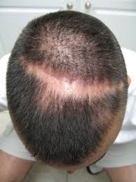 Excessive use can lead to felting of hair, leading to breakage and even more hair loss. Use Castor Oil To Stop Male Receding Hairline Visihow