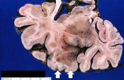 Image result for HSV Encephalitis