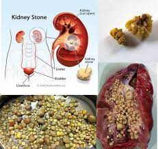 Segala informasi tertera tidak menggantikan nasihat atau arahan doktor. Helmi Senpai ãƒ˜ãƒ«ãƒŸå…ˆè¼© V Twitter Kidney Stone Nephrolithiasis Penyakit Batu Karang Buah Pinggang What Is The Cause How Did It Happen Things You Need To Know Nephrology Internalmedicine