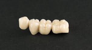 How much does a dental bridge cost? Do You Need A Dental Bridge 4 Types Cost Uses Alternatives
