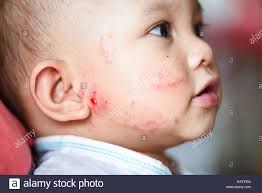 Baby Allergie Hautausschlag Im Gesicht Krankheit Baby Girl Gesicht Trockene Haut Juckreiz Und Lasion Verursacht Von Allergie In Den Neugeborenen Baby Asien Stockfotografie Alamy