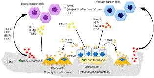 Mechanisms of osteoblastic bone metastasis in prostate cancer: Cancers Free Full Text The Osteoclast In Bone Metastasis Player And Target Html