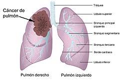 Cáncer - Wikipedia, la enciclopedia libre