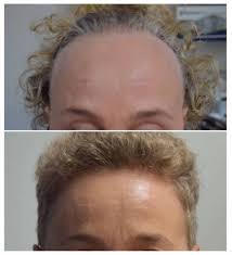 Androgenetic alopecia coexistent with aa is allowed. Cureus Alopecia Areata Mimicking Frontal Fibrosing Alopecia