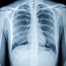 If you do have these symptoms, see your doctor. Chest X Ray For The Diagnosis Of Lung Cancer