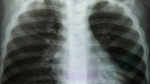 Die copd bezeichnet als sammelbegriff eine gruppe von krankheiten der lunge, die durch husten, vermehrten. Copd Medikationsmanagement Bei Chronisch Obstruktiver Lungenerkrankung