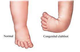 In club foot, 1 foot or both feet point down and inwards with the sole of the foot facing backwards. Introduction To Clubfoot Physiopedia