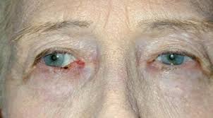 You may notice a waxy lump or a small, smooth, shiny, or pale growth. Basal Cell Carcinoma Practice Essentials Background Pathophysiology