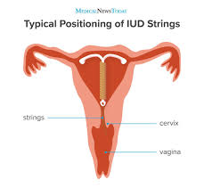 Can i drive myself home after the insertion procedure? Can T Feel Iud Strings 4 Reasons Why And What To Do