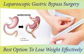 laparoscopic gastric byp surgery