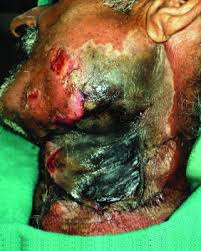 Necrotizing fasciitis is a subset of the aggressive skin and soft tissue infections (sstis) that cause necrosis of the muscle fascia and subcutaneous tissues. Facial Necrotizing Fasciitis From An Odontogenic Infection Oral Surgery Oral Medicine Oral Pathology And Oral Radiology