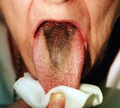 Image result for black hairy tongue symptoms