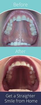 Smilecareclub Invisible Aligners Done At Home Health And Beauty Beauty Care Beauty Health