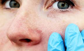 Elle n'est plus exploitée aujourd'hui. Laser Rosacee Couperose Lyon Chirurgie Dermatologique Magis