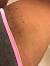 Ingrown Hair Bikini Line Large Lump