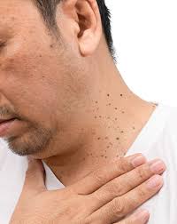 Image result for Skin Tag