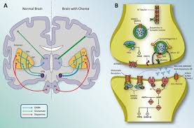 Image result for Chorea