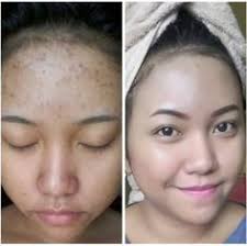4 Cara Menghilangkan Bekas Jerawat Secara Alami Dalam Waktu 3 Hari Jerawat Produk Jerawat Masker Wajah Buatan Rumah
